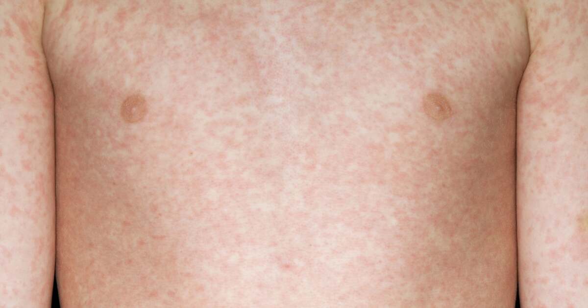 Measles, the “infant disease” with over 90% contagiousness and respiratory transmission.  Signs and treatment